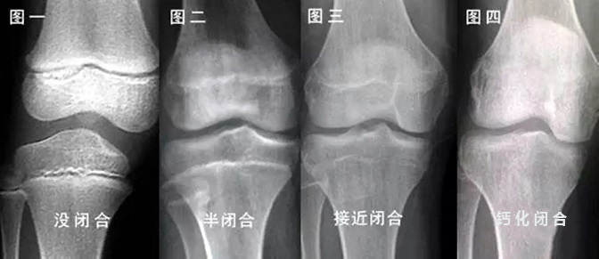 is_epiphyseal_line_close